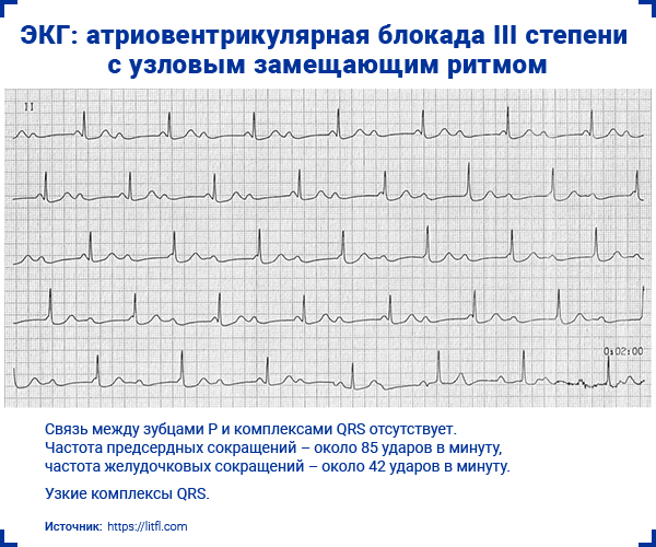 ЭКГ атриовентрикулярная блокада III степени с узловым замещающим ритмом